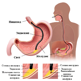 Гастроскопия